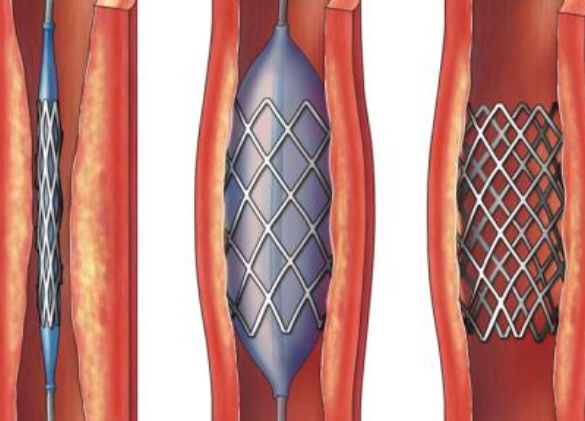 好消息！700元冠脈支架來了帶量采購結(jié)果在甘肅省正式落地執(zhí)行